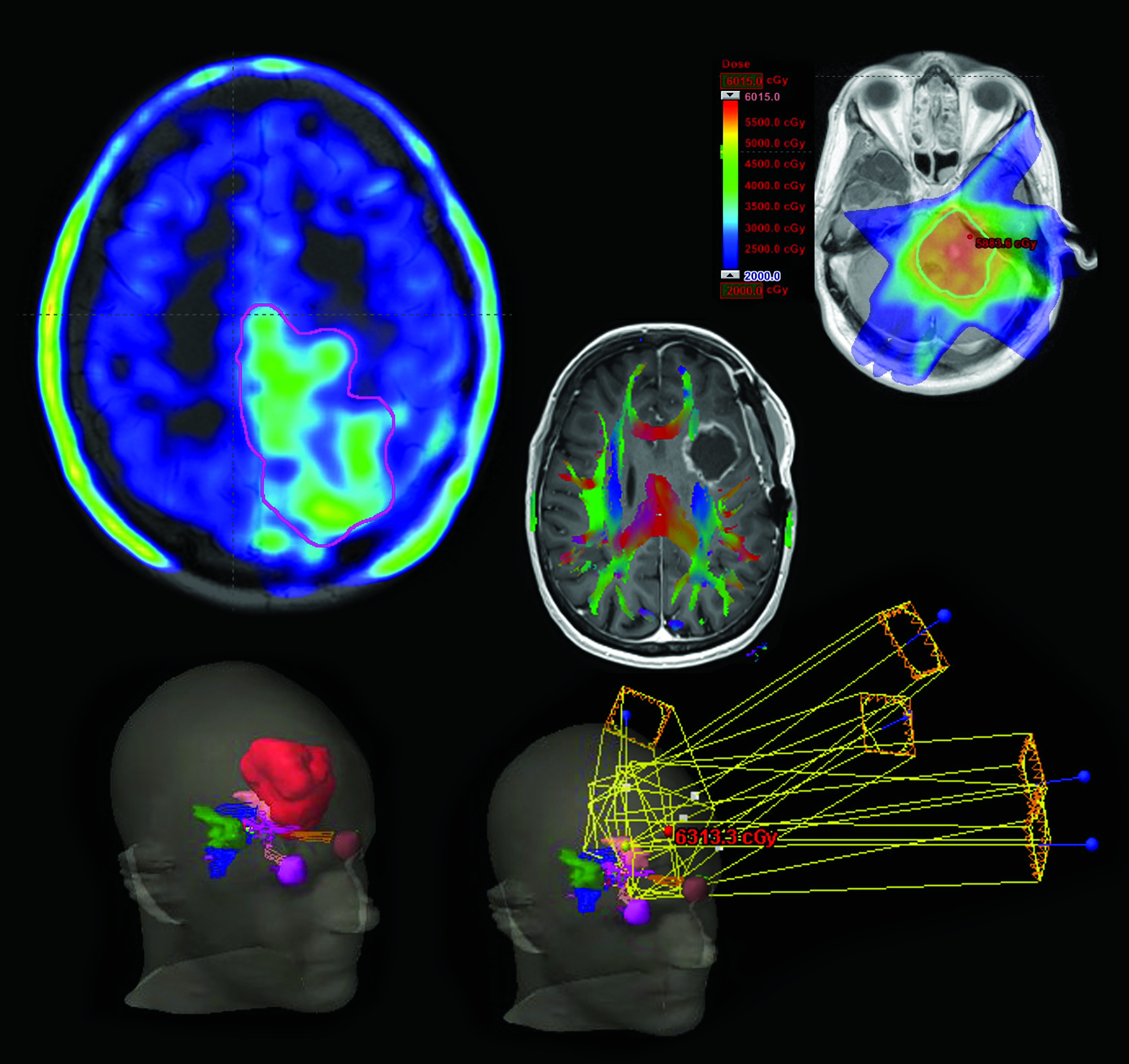 Brain Cancer Databank The Brain Cancer Group